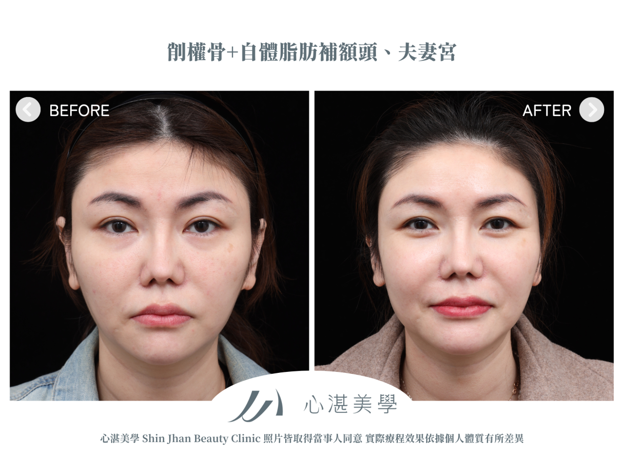 顴骨內推+自體脂肪補額頭夫妻宮案例分享