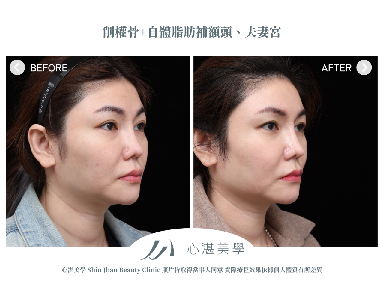 顴骨內推+自體脂肪補額頭夫妻宮案例分享