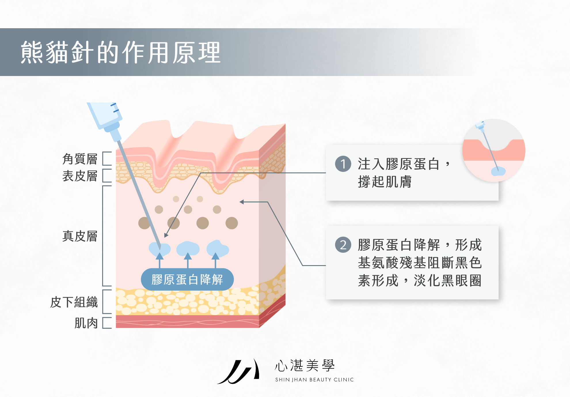 熊貓針的作用原理