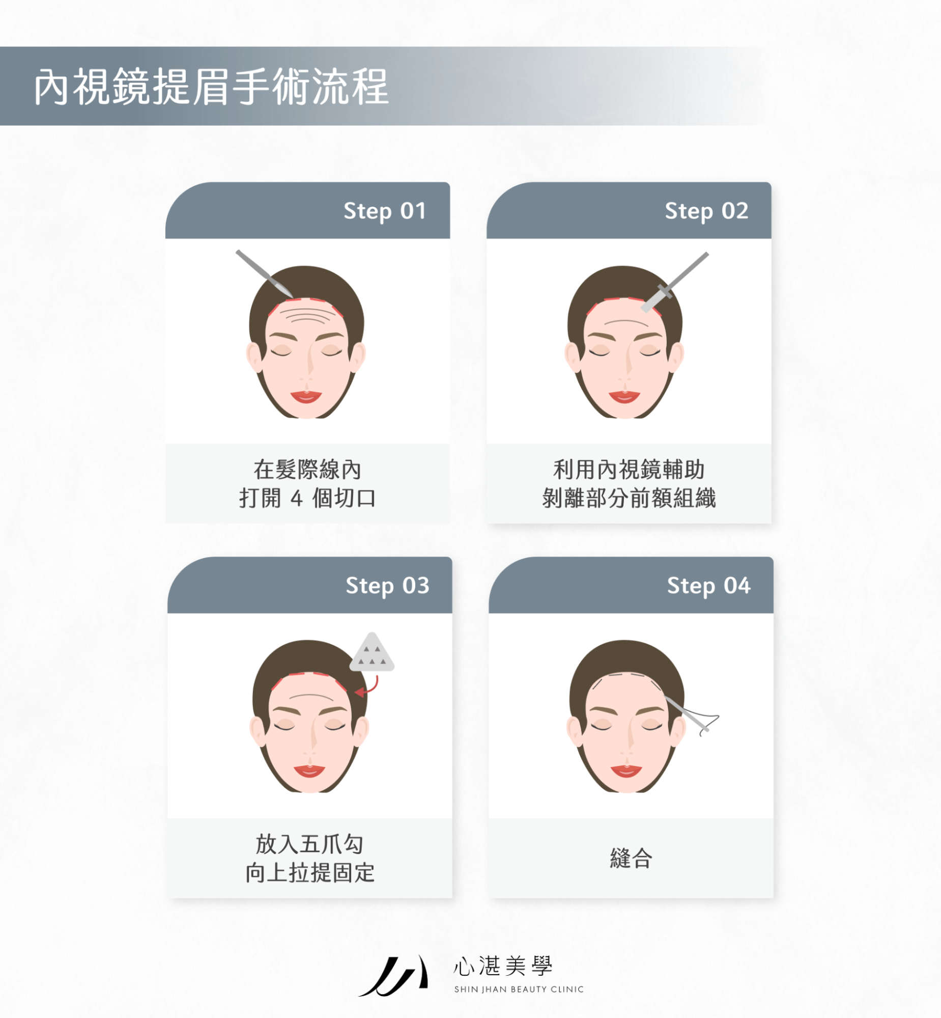 內視鏡提眉手術流程