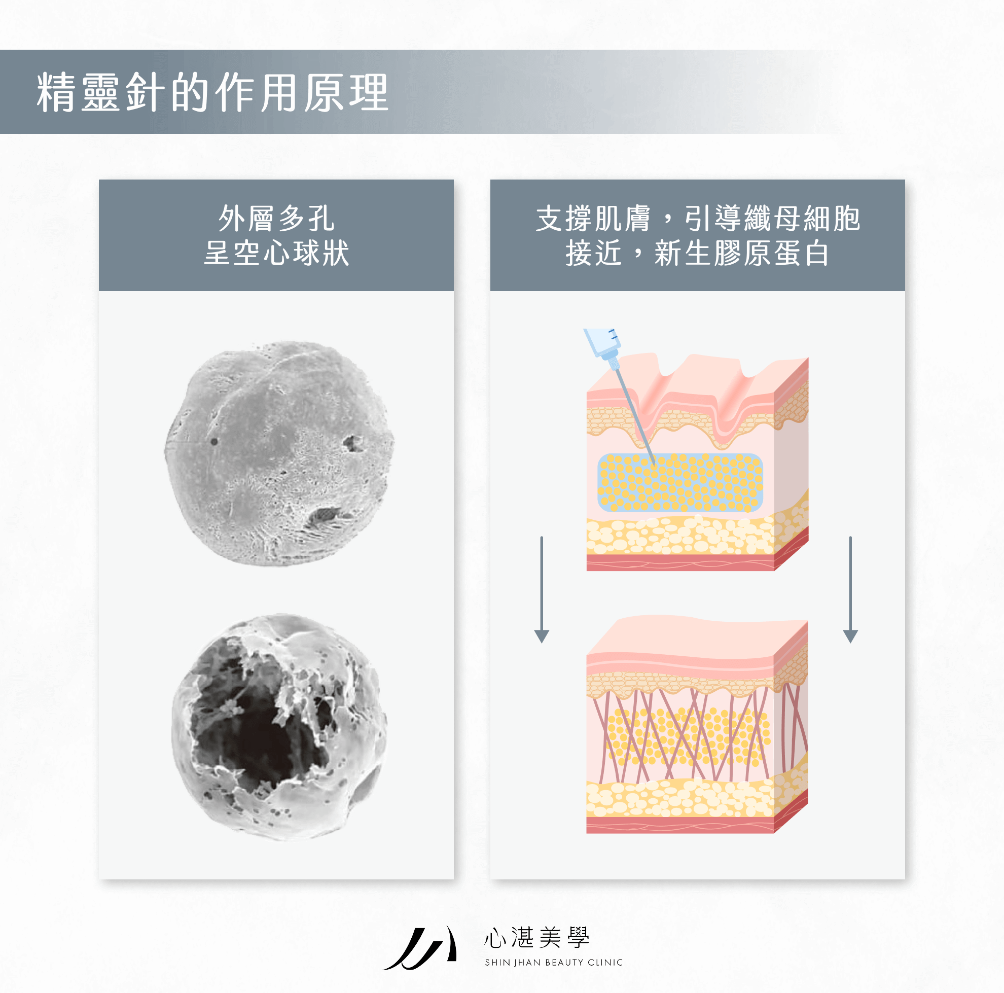 精靈針的作用原理 