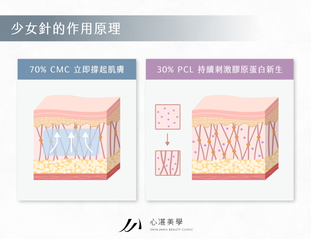 少女針的作用原理