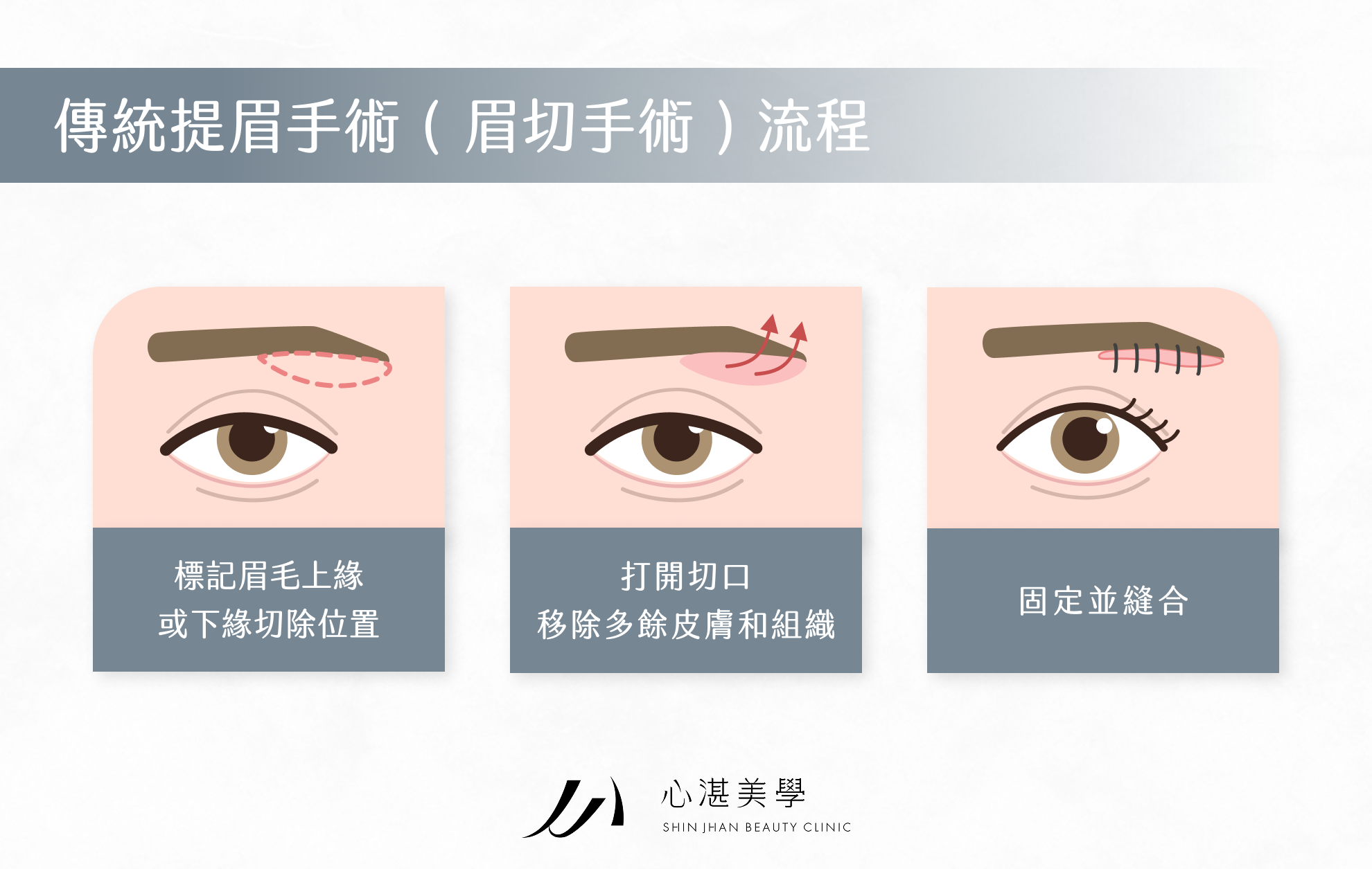 傳統提眉手術（眉切手術）流程