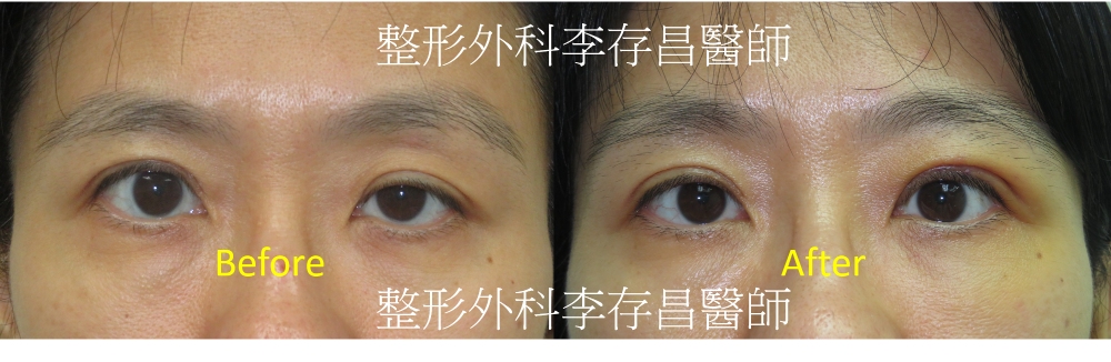 真實案例 3：雙眼皮手術＋提眼瞼肌矯正，重建自然對稱雙眼