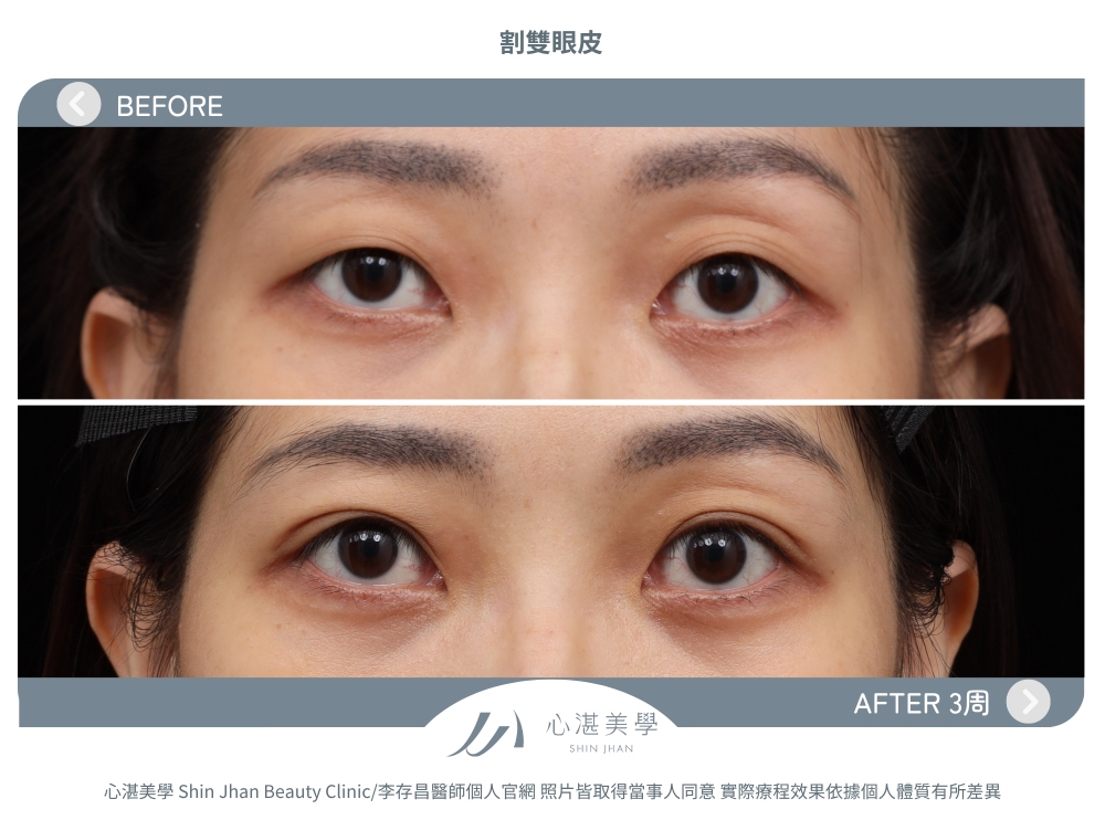 真實案例 1：雙眼皮手術＋脂肪轉位，打造自然對稱大眼