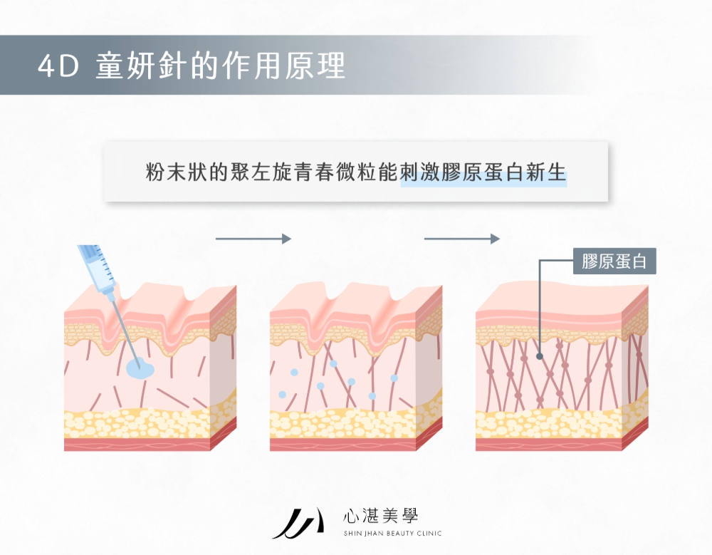  4D 童妍針的作用原理