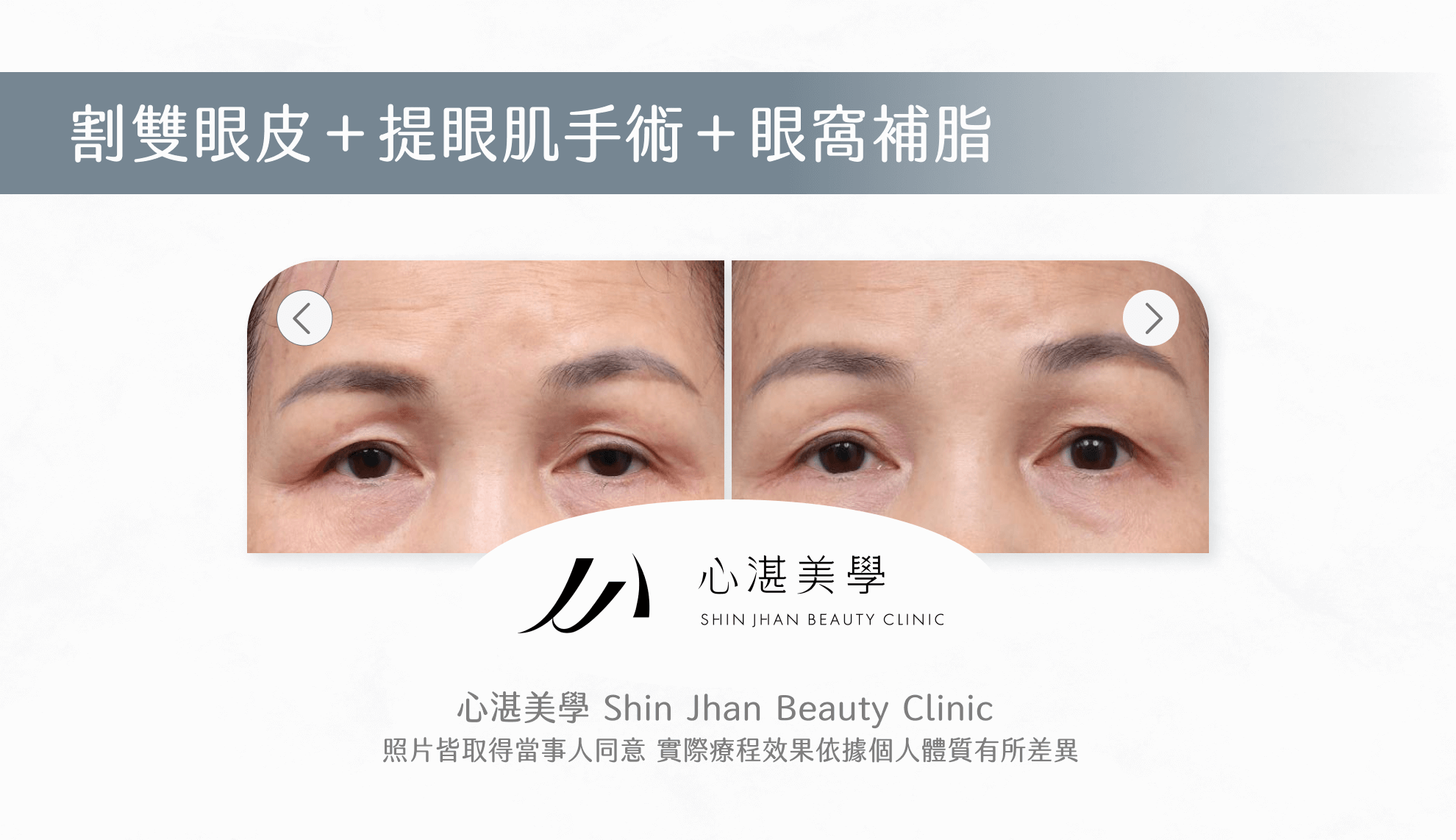 提眼肌手術案例圖片