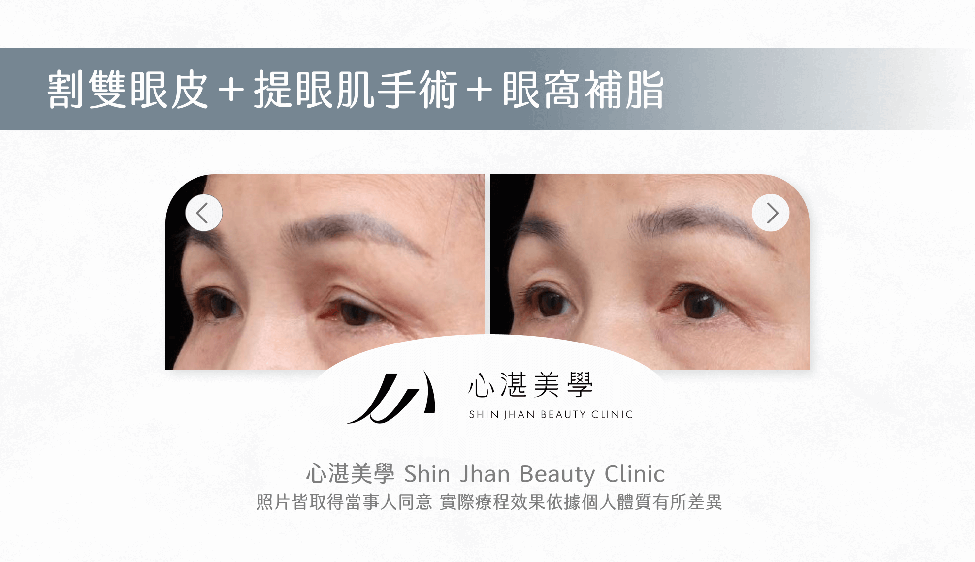 提眼肌手術案例圖片