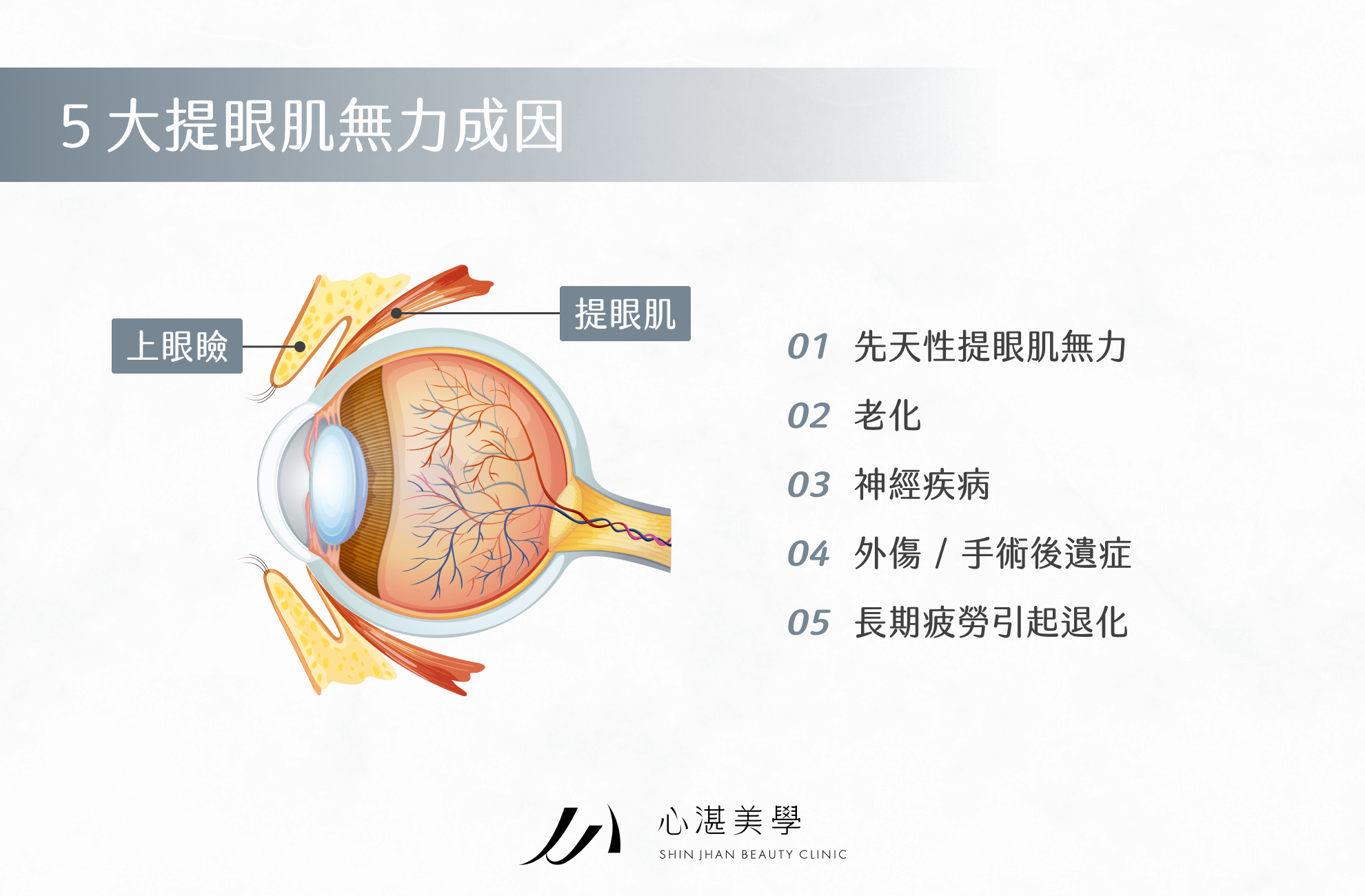 5 大提眼肌無力成因