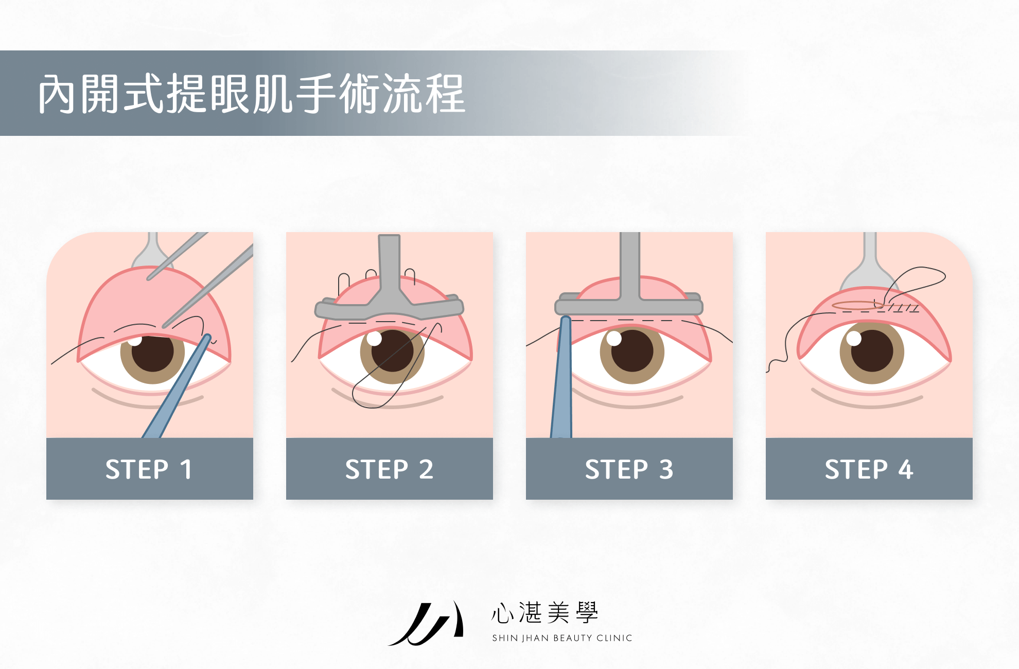 內開式提眼肌手術流程