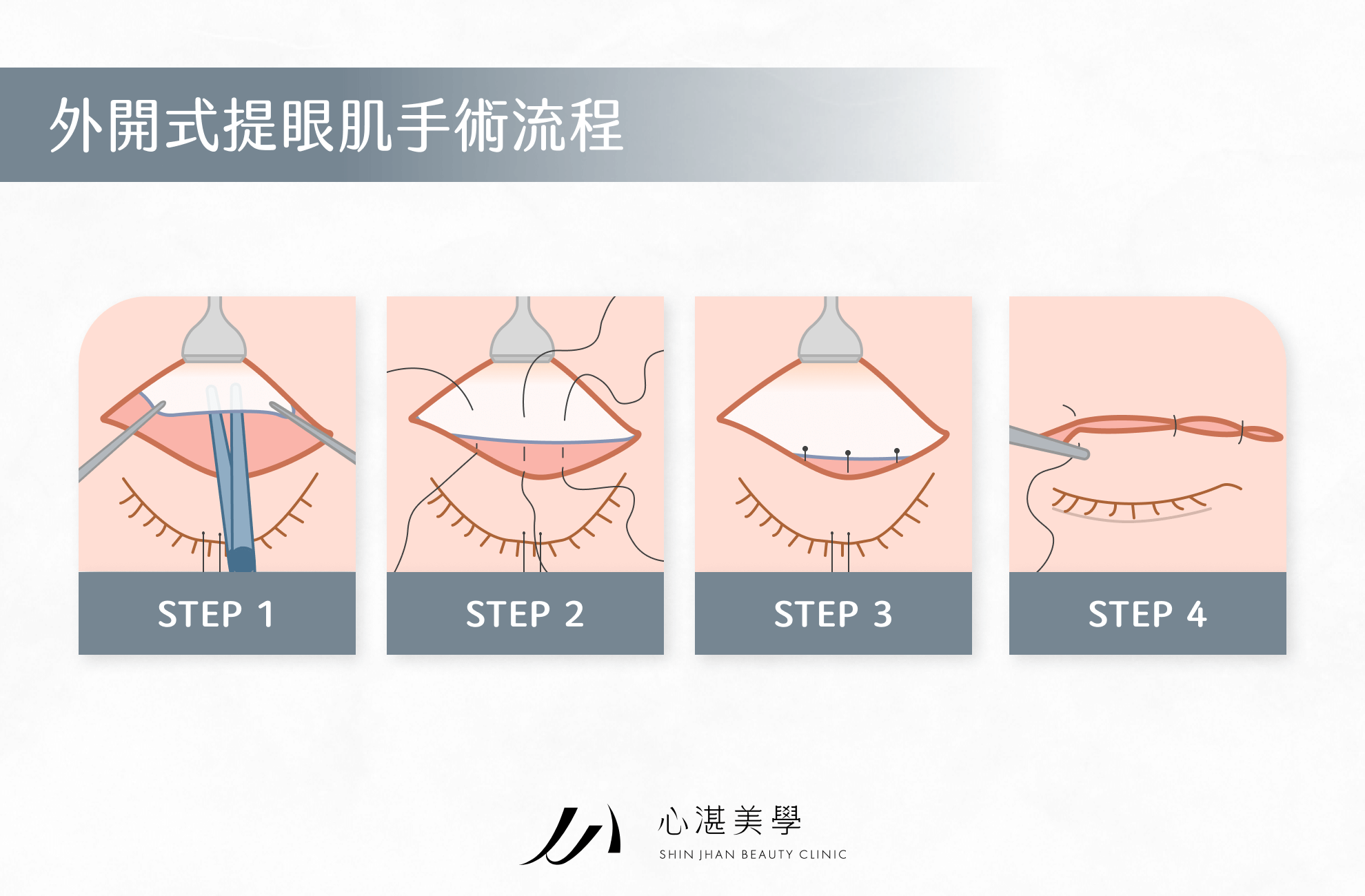 外開式提眼肌手術流程