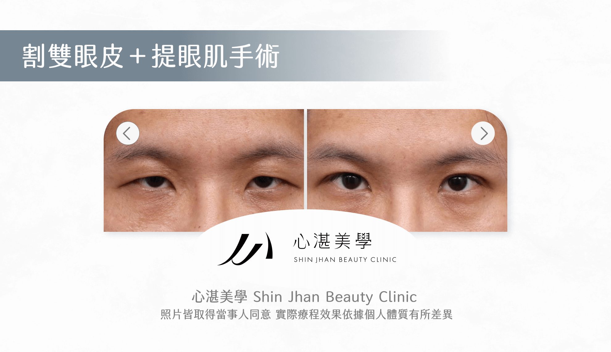 提眼肌手術案例圖片