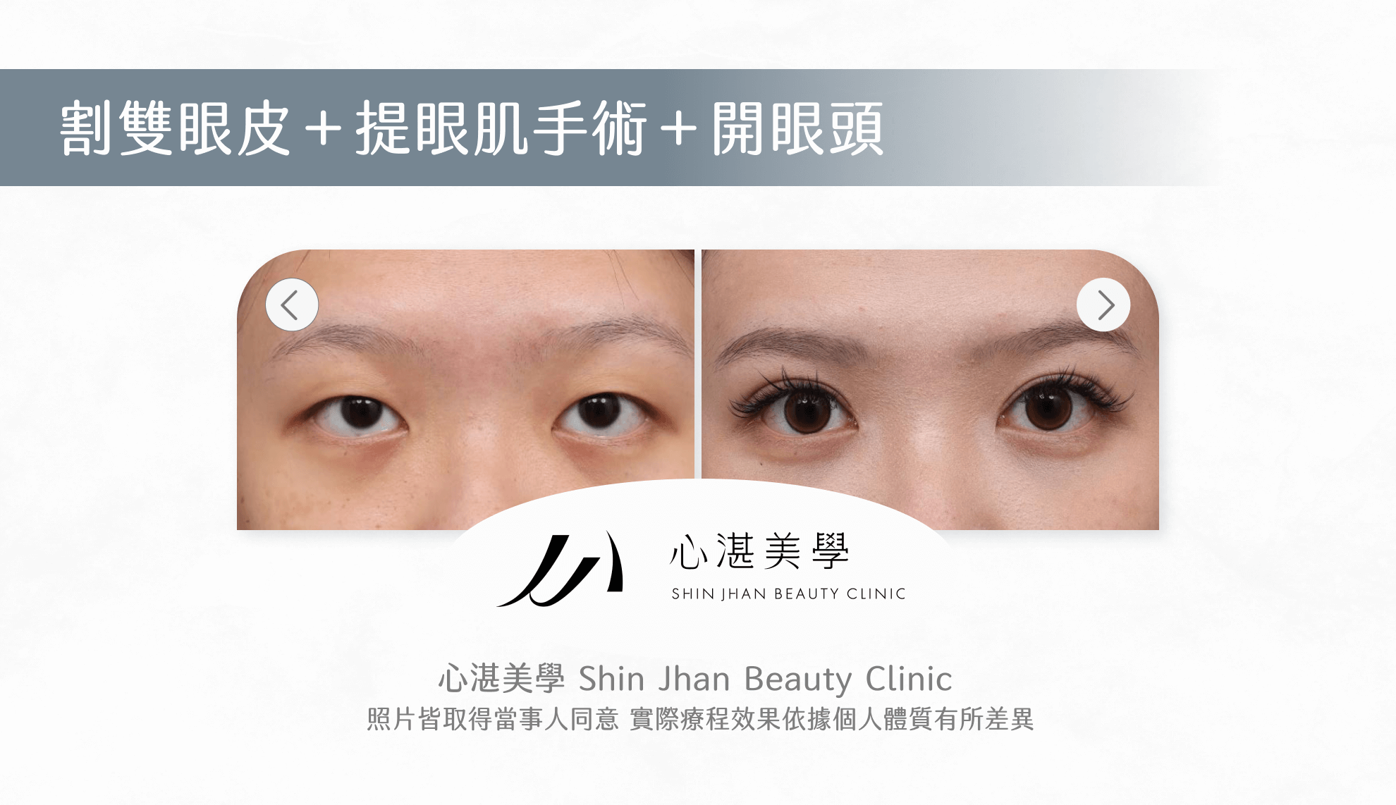 提眼肌手術案例圖片