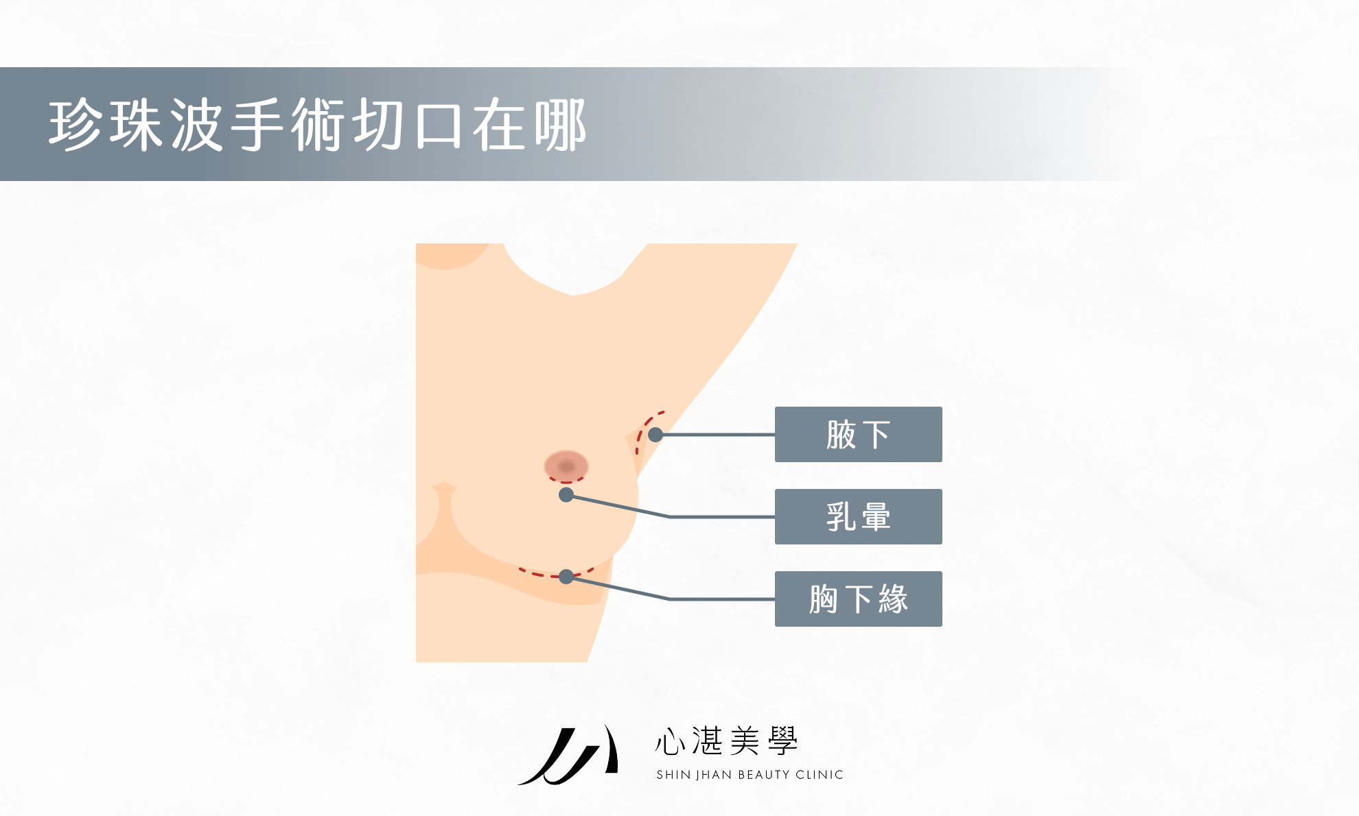 珍珠波手術切口在哪