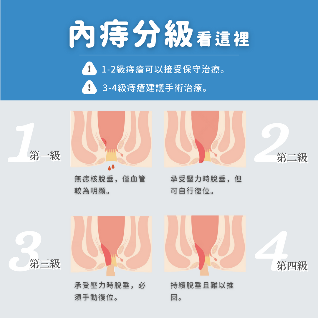 內痔分級看這裡！