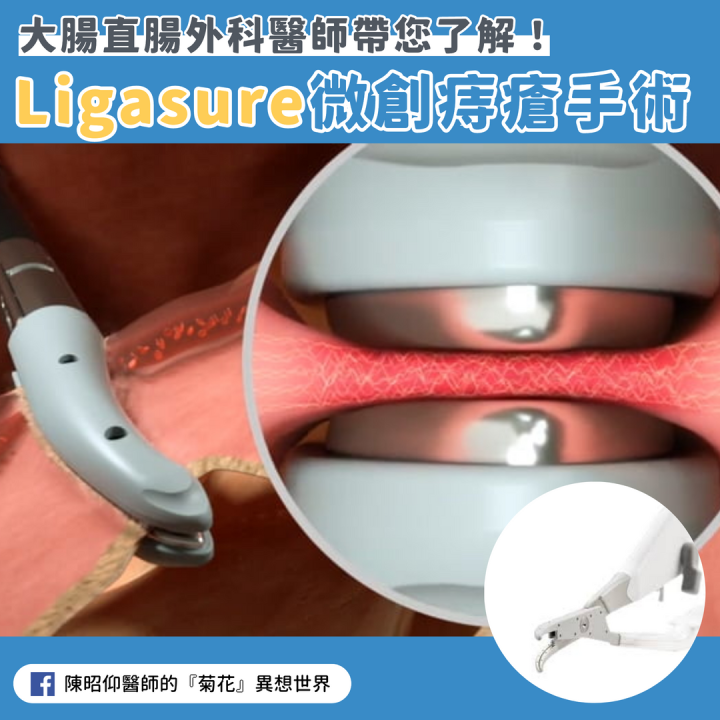 微創痔瘡手術常出現的組織凝集刀Ligasure是什麼？