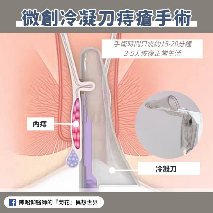 解決「痔瘡」的好朋友：PPH痔瘡環狀切除手術
