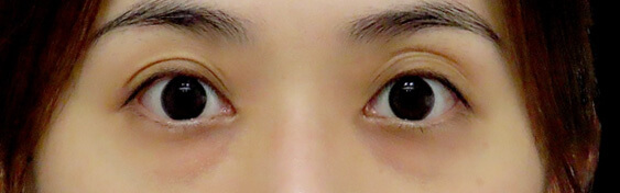 血管型黑眼圈