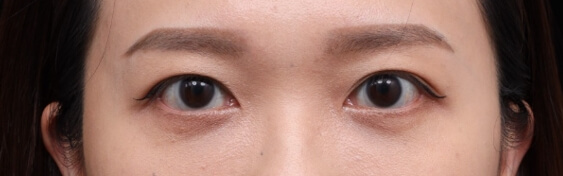 色素型黑眼圈