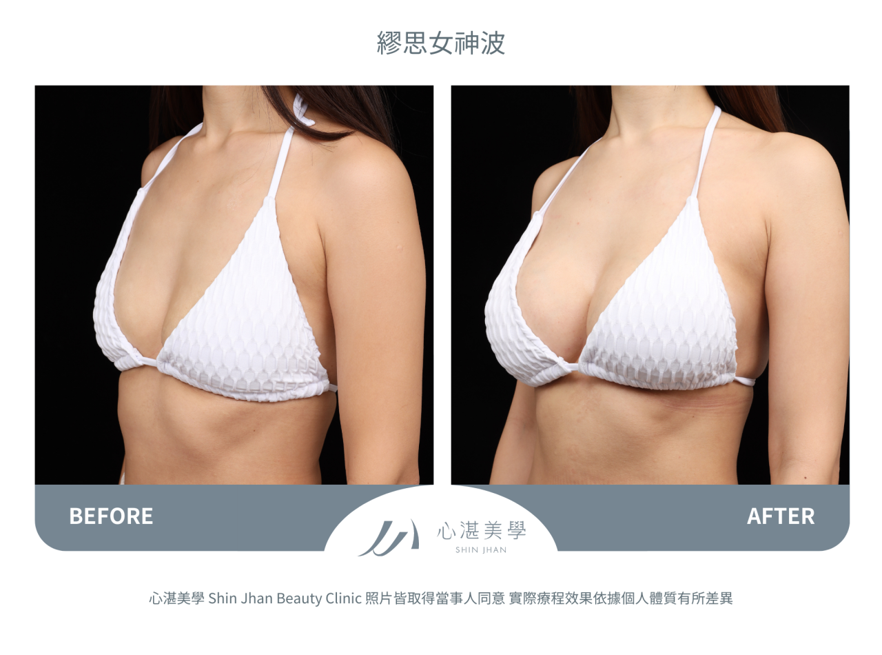 繆思女神波術前術後分享