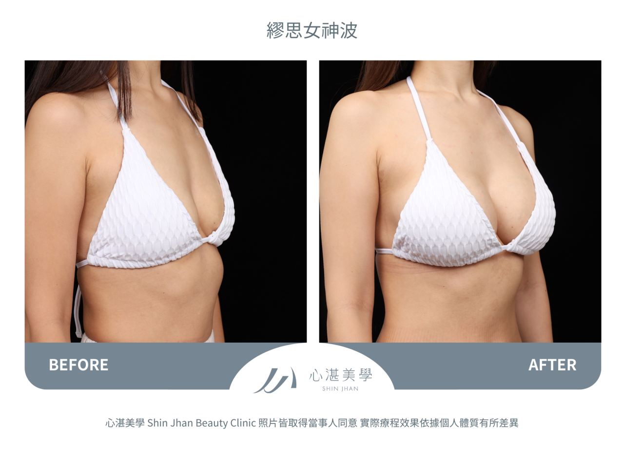 繆思女神波術前術後分享