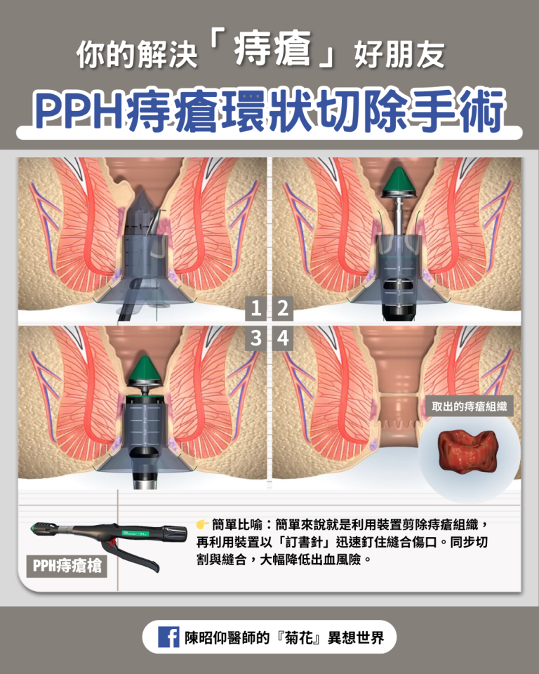 解決「痔瘡」的好朋友：PPH痔瘡環狀切除手術