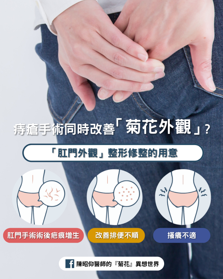 「痔瘡手術」同時改善「菊花外觀」：肛門贅皮整形