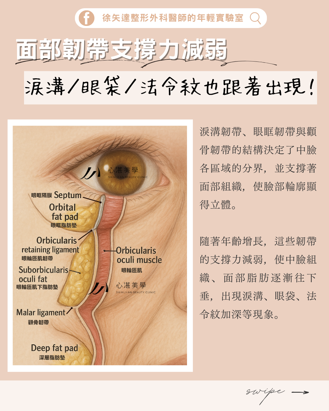 面部韌帶支撐力減弱，淚溝、眼袋、法令紋也跟著出現！淚溝韌帶、眼眶韌帶、顴骨韌帶決定中臉區域分界，支撐面部組織，使臉部輪廓顯得立體！