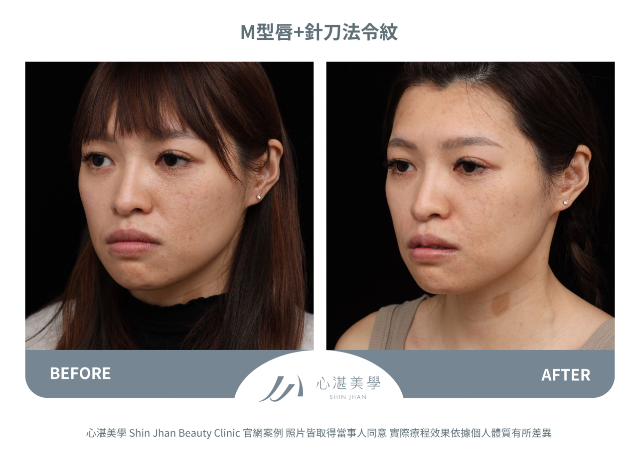 脂肪填補M字唇珠+針刀無痕法令紋平滑術案例分享