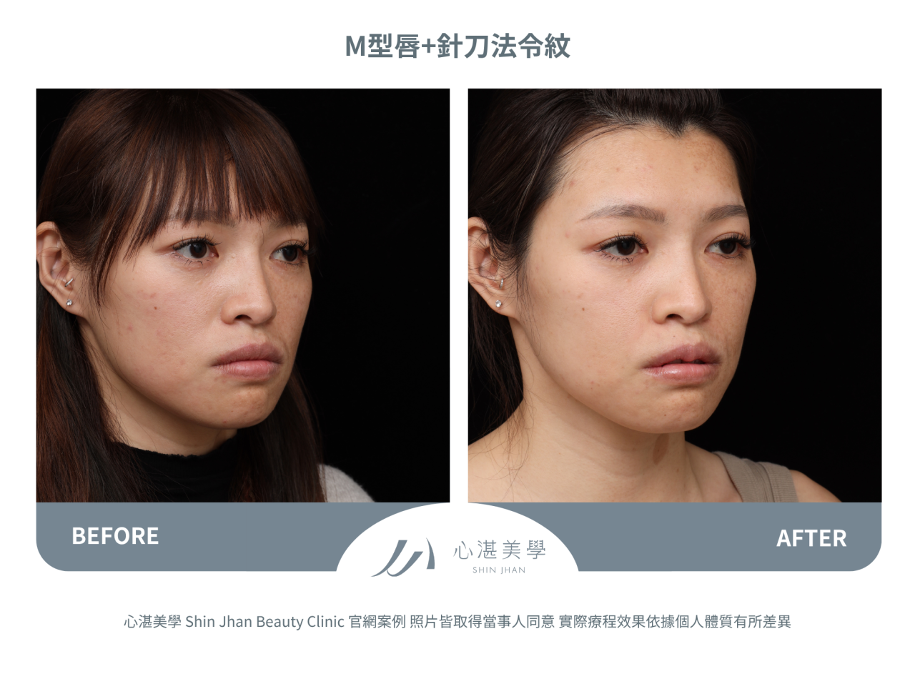 脂肪填補M字唇珠+針刀無痕法令紋平滑術案例分享