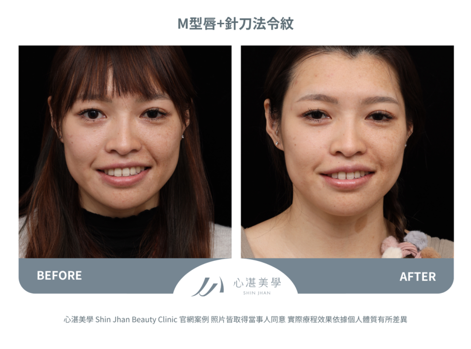 脂肪填補M字唇珠+針刀無痕法令紋平滑術案例分享