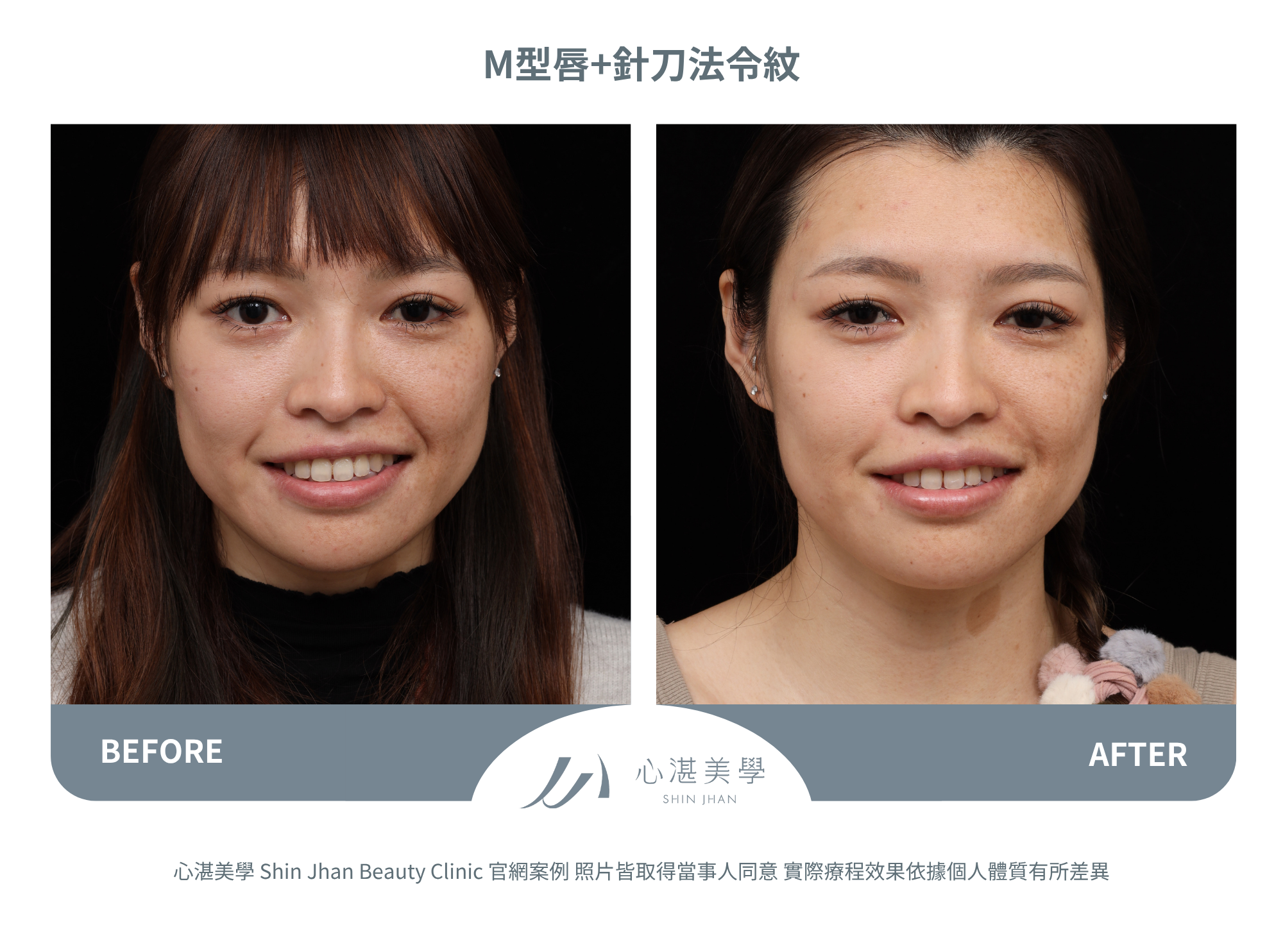 脂肪填補M字唇珠+針刀無痕法令紋平滑術案例分享