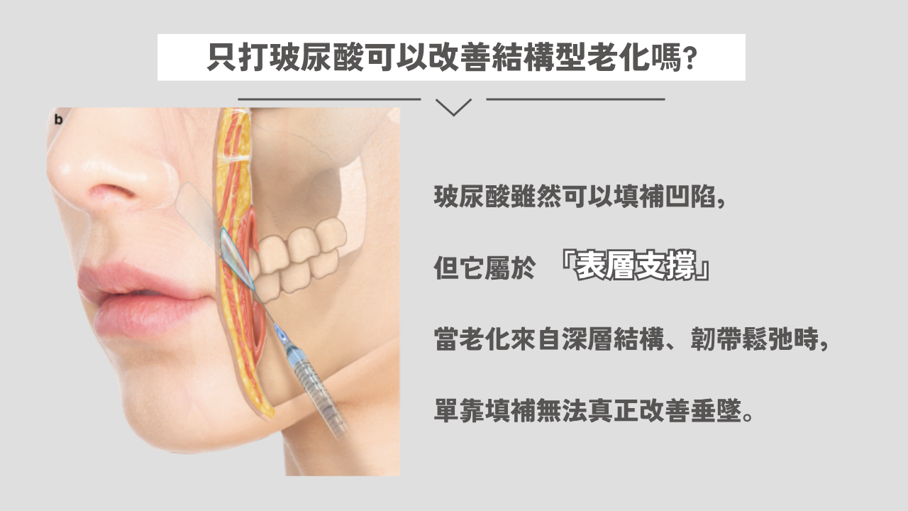 玻尿酸填充可以改善結構型老化嗎