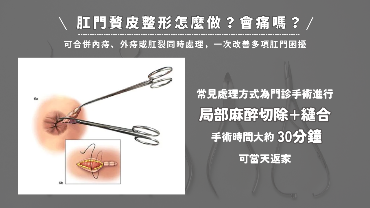 肛門贅皮整形怎麼做?會痛嗎?