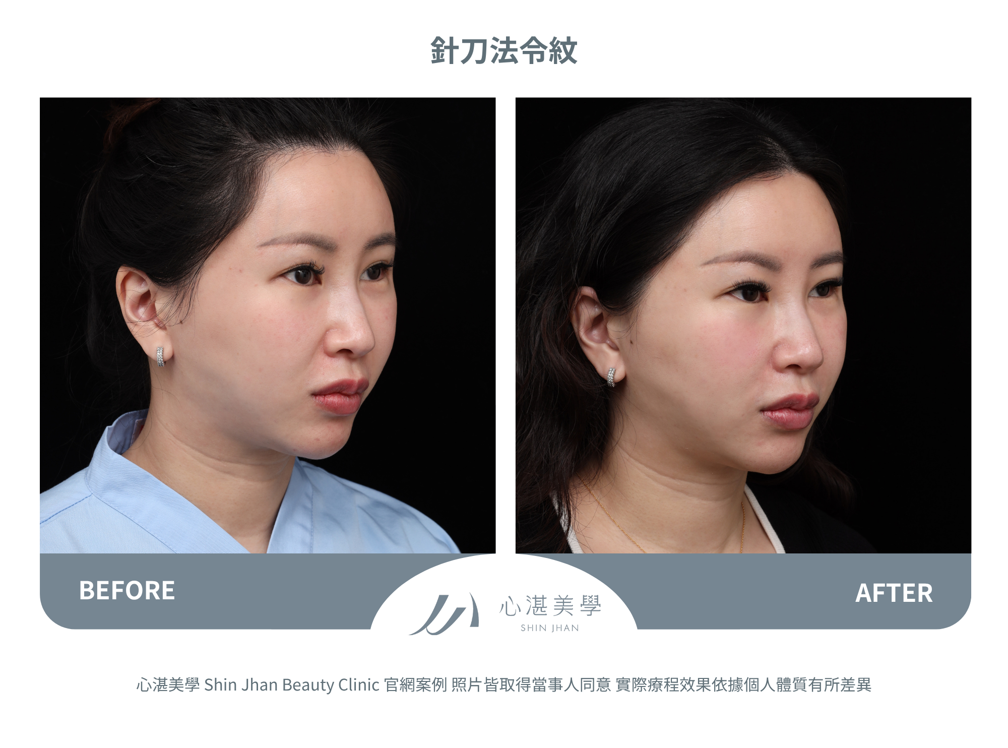 針刀無痕法令紋平滑術案例分享