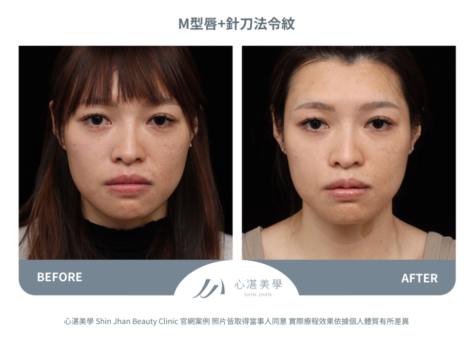 脂肪填補M字唇珠+針刀無痕法令紋平滑術案例分享