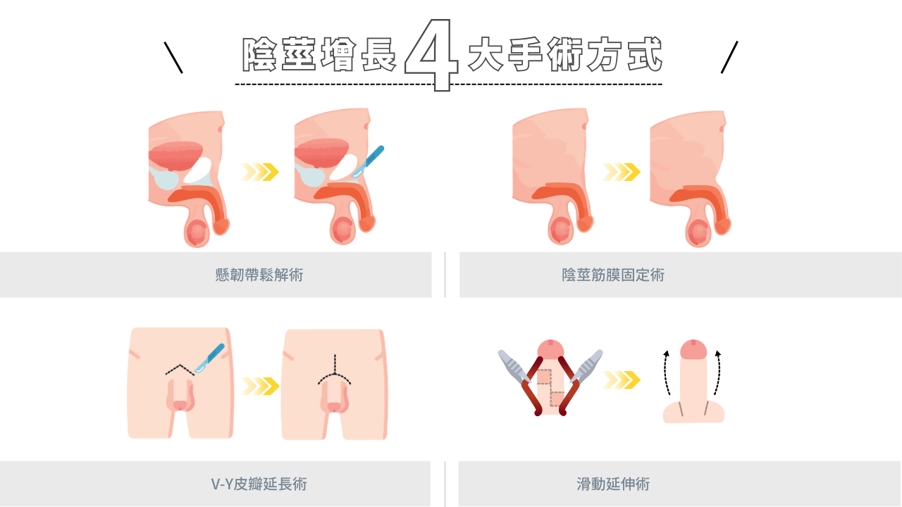 陰莖增長手術怎麼做?原理與方式介紹