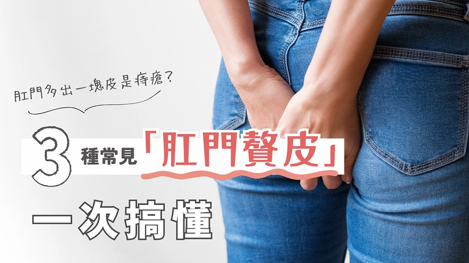 3種常見「肛門贅皮」真相一次搞懂