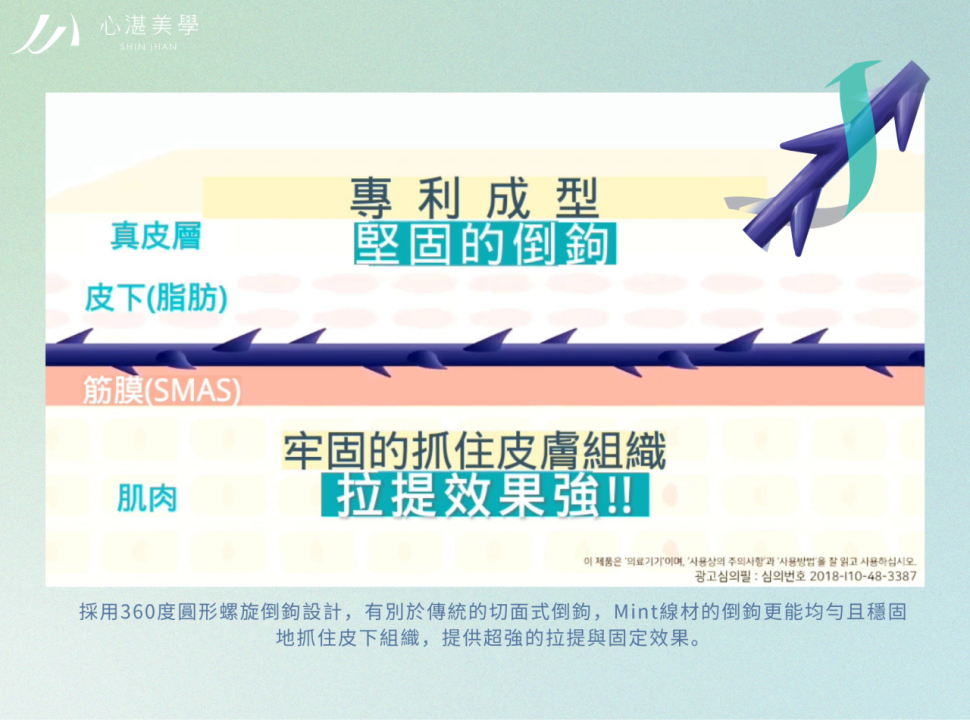 Mint神力拉提專利360度倒鉤線材,深入真皮層與筋膜層,有效抓取鬆弛組織,提供強效拉提支撐。