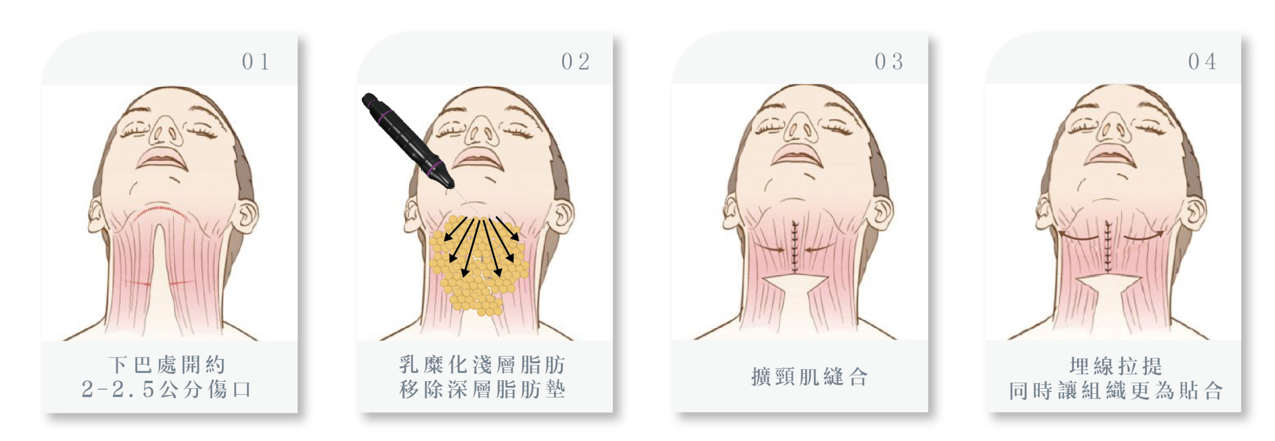 天鵝頸手術流程介紹！比別人多一步驟，效果更凸顯！
