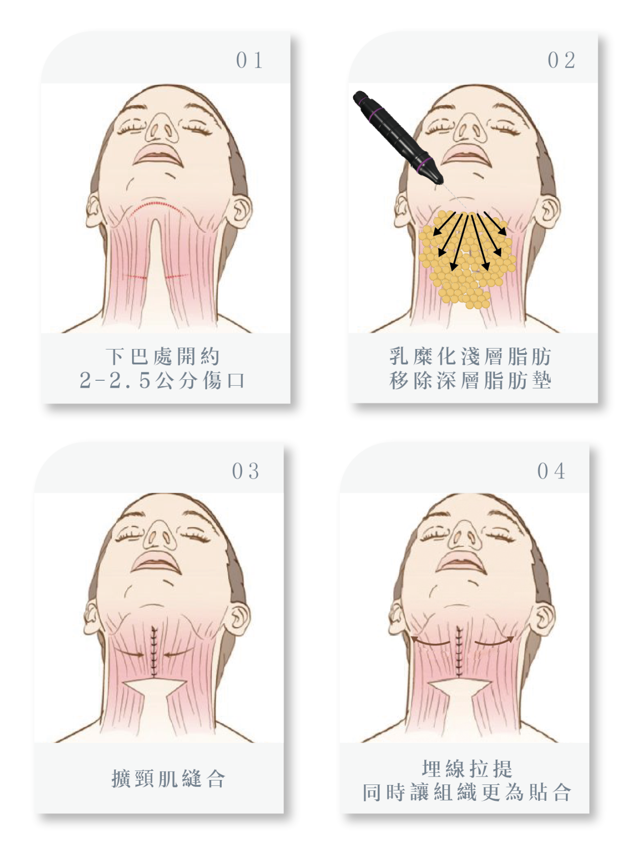 天鵝頸手術流程介紹！比別人多一步驟，效果更凸顯！