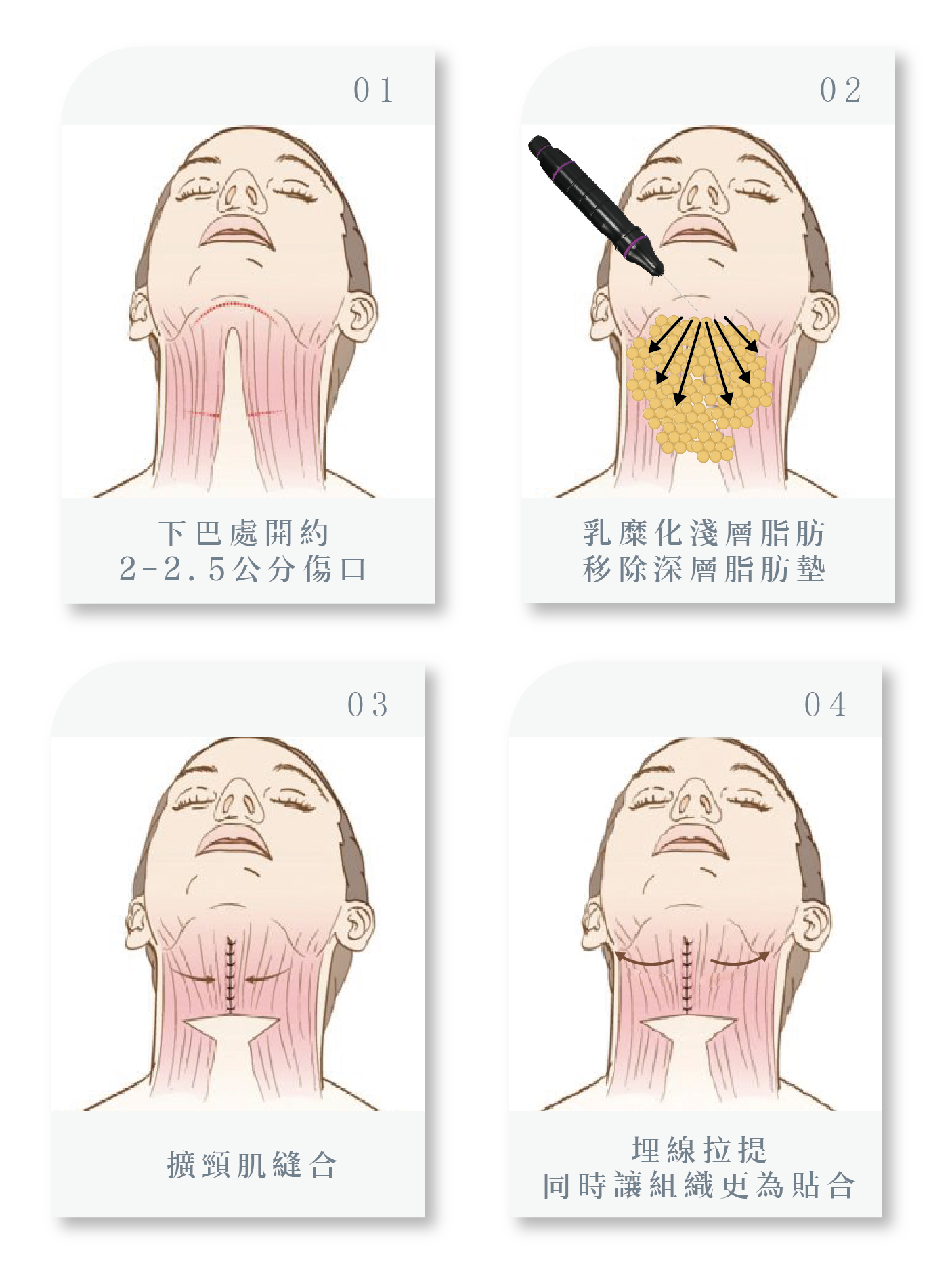 天鵝頸手術流程介紹！比別人多一步驟，效果更凸顯！