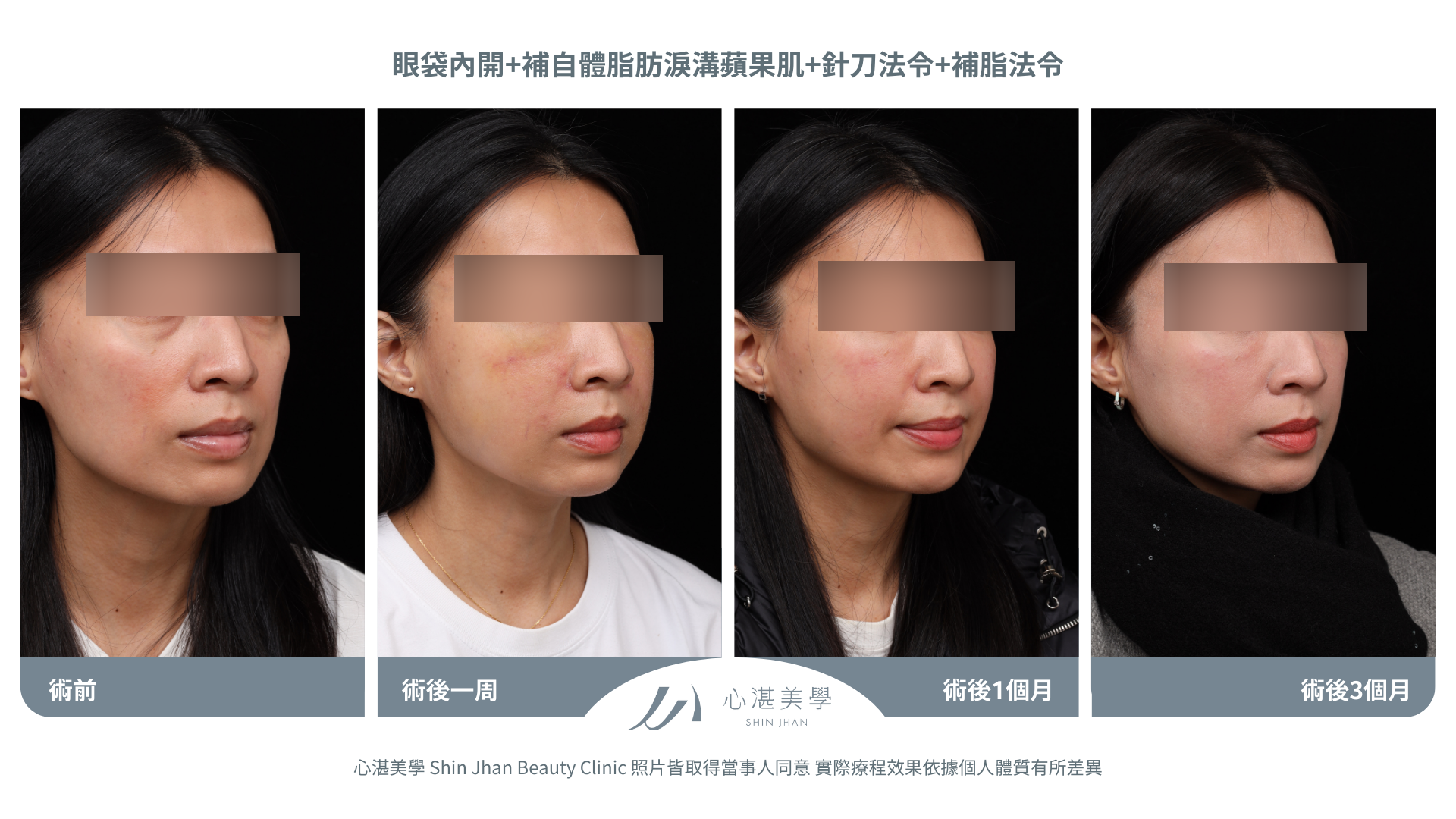 針刀無痕法令紋平滑術前術後對比
