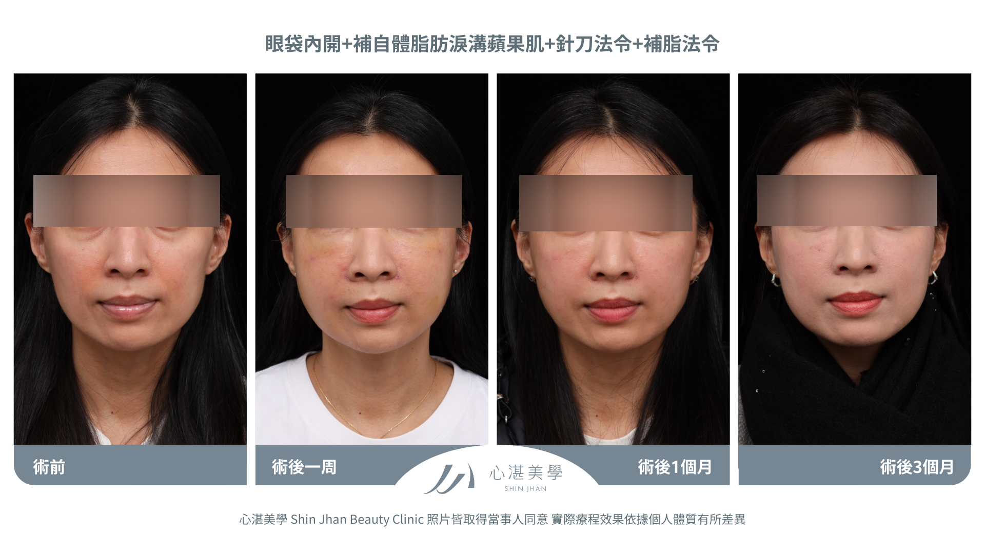 針刀無痕法令紋平滑術前術後對比