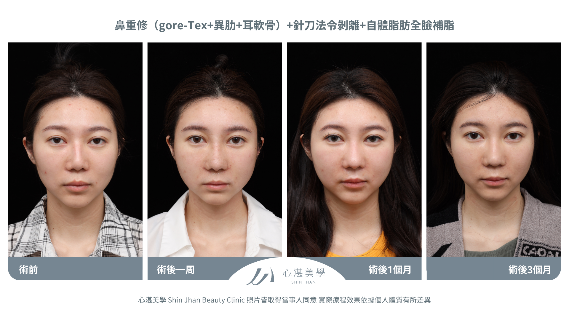 針刀無痕法令紋平滑術前術後對比