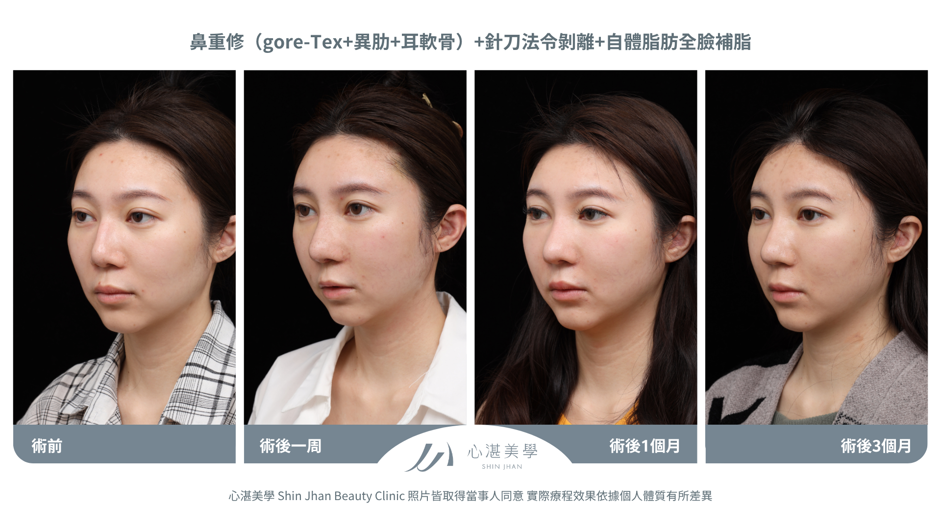 針刀無痕法令紋平滑術前術後對比