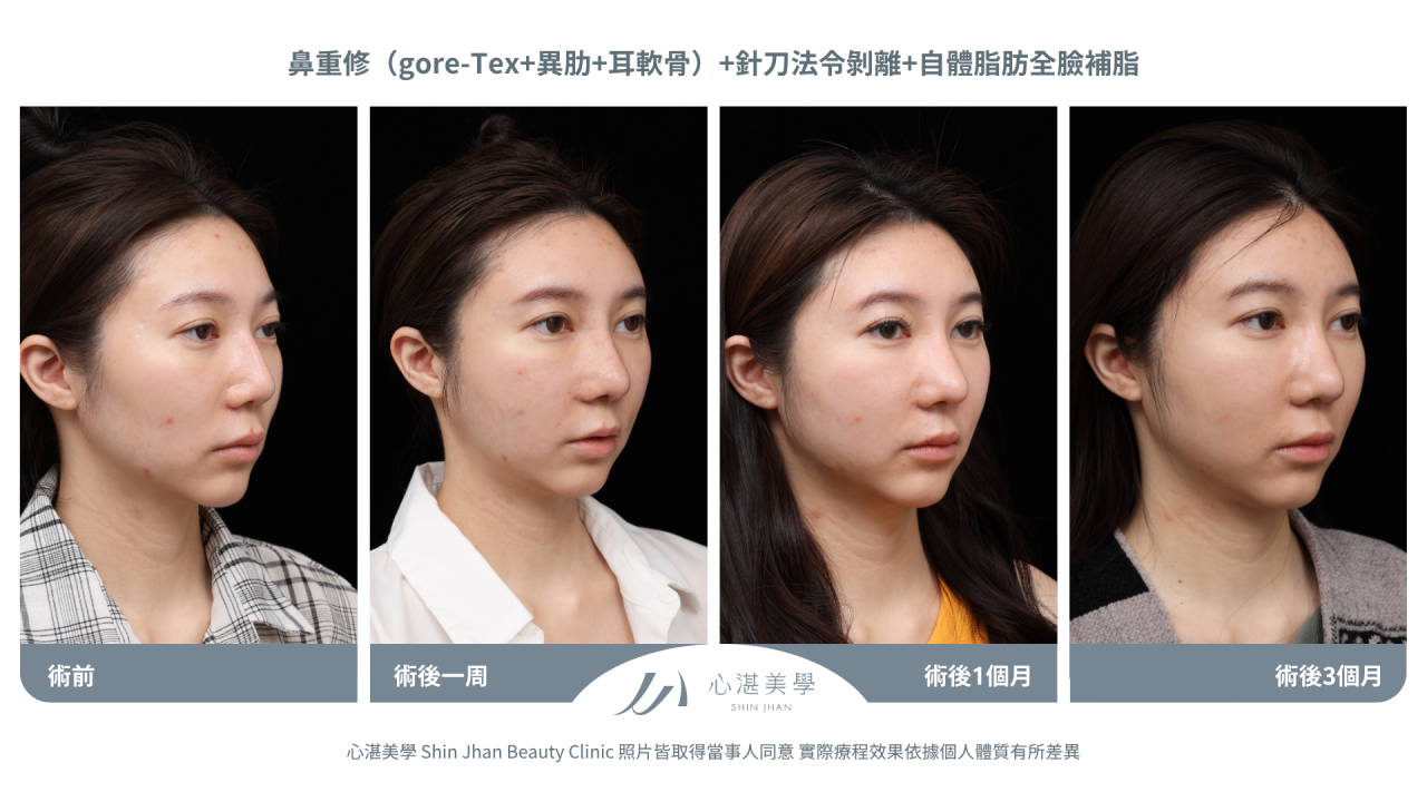 針刀無痕法令紋平滑術前術後對比