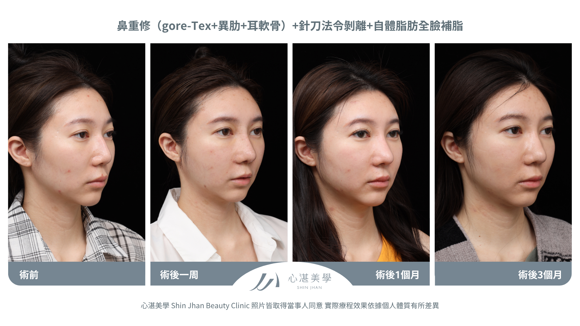 針刀無痕法令紋平滑術前術後對比