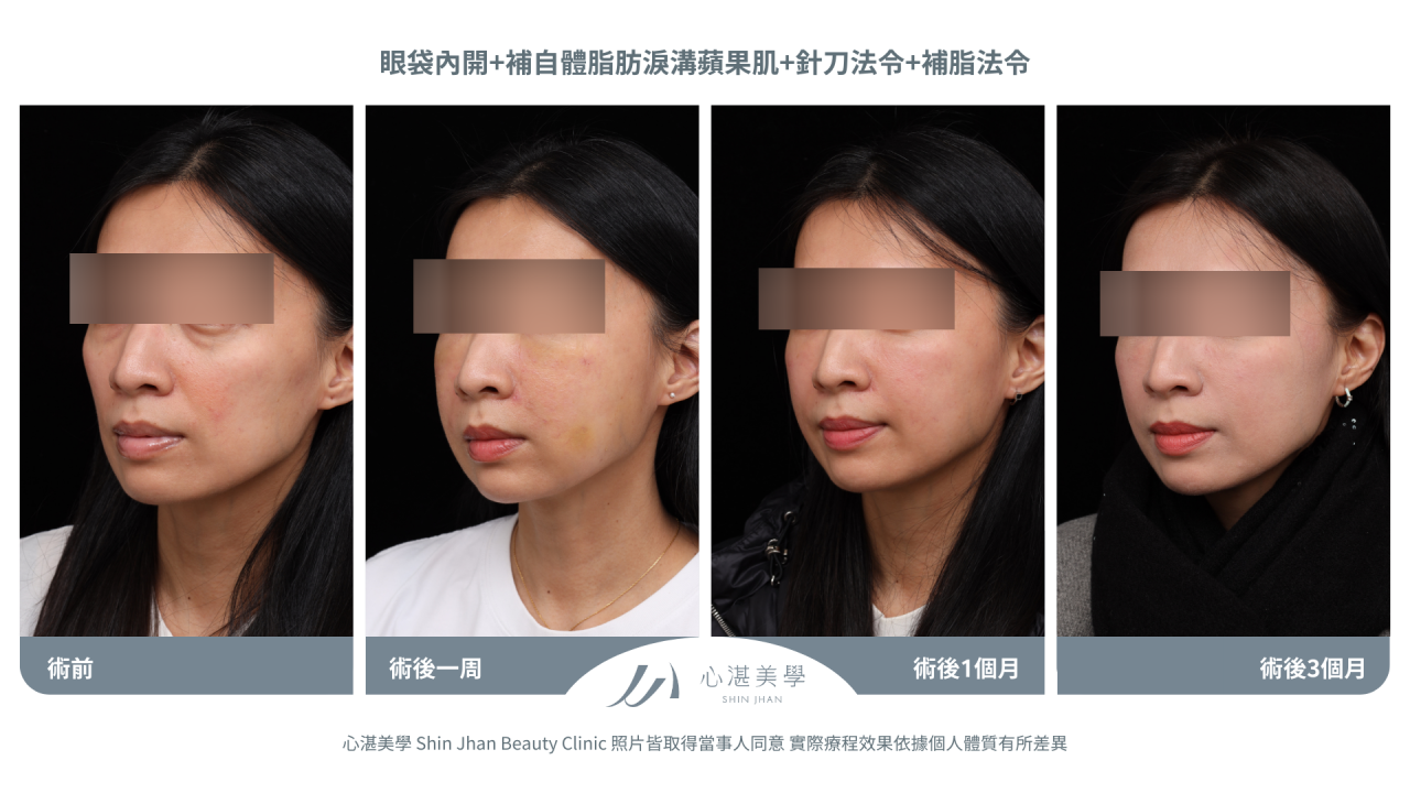 針刀無痕法令紋平滑術前術後對比