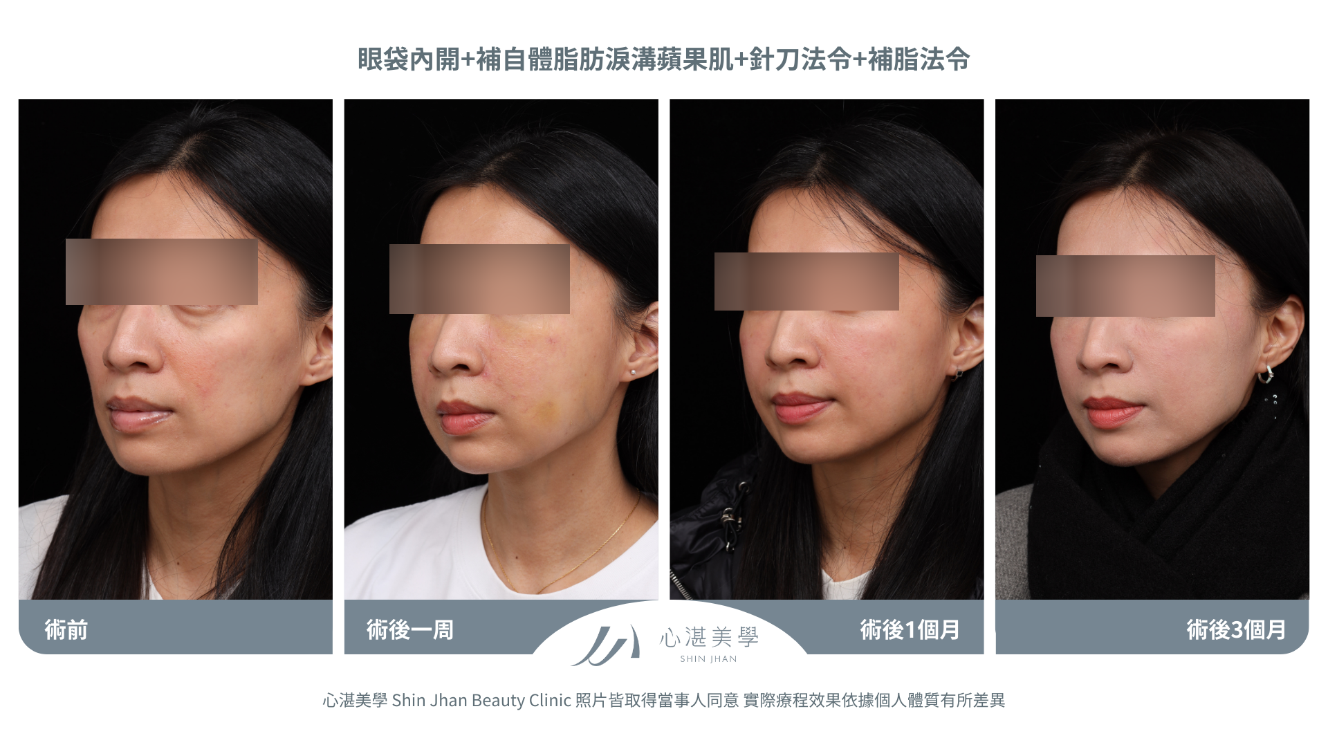 針刀無痕法令紋平滑術前術後對比